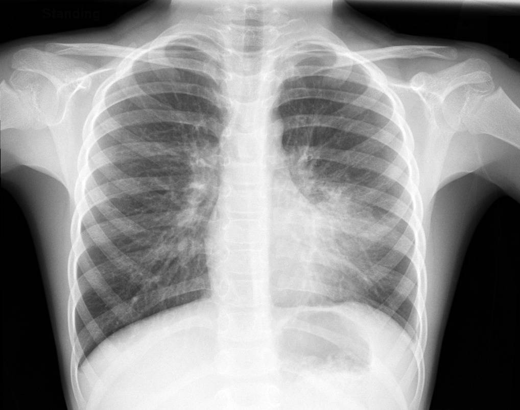 Пневмония на рентгене: как выглядит воспаление легких на рентгеновском снимке, рентгенологические признаки