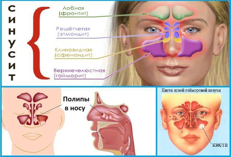 Этмоидит - симптомы и лечение у взрослых: полипозный, катаральный, этмоидальный, левосторонний фронтит