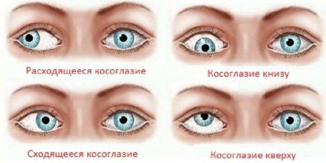 Операция по исправлению косоглазия (страбизма): виды, методы лечения и коррекции – глазная клиника новый взгляд