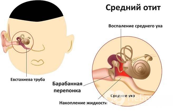 Гнойный отит у ребенка (40 фото): симптомы, признаки и лечение острого гнойного отита и среднего уха в домашних условиях у новорожденного