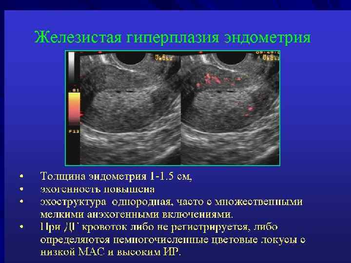 Железисто-кистозная гиперплазия эндометрия