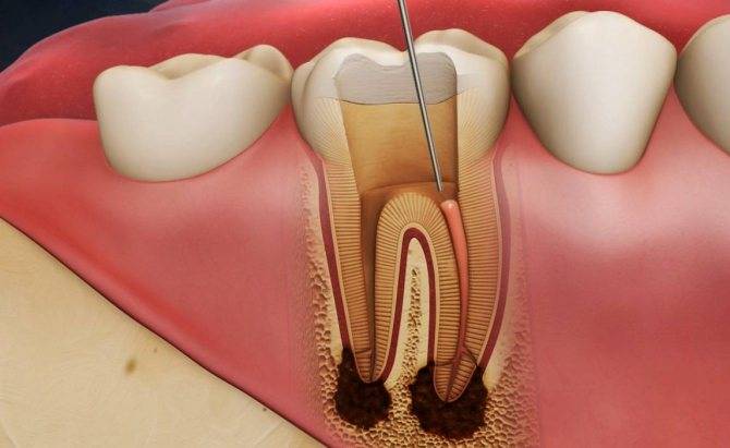 Депульпация зуба перед протезированием - цена процедуры