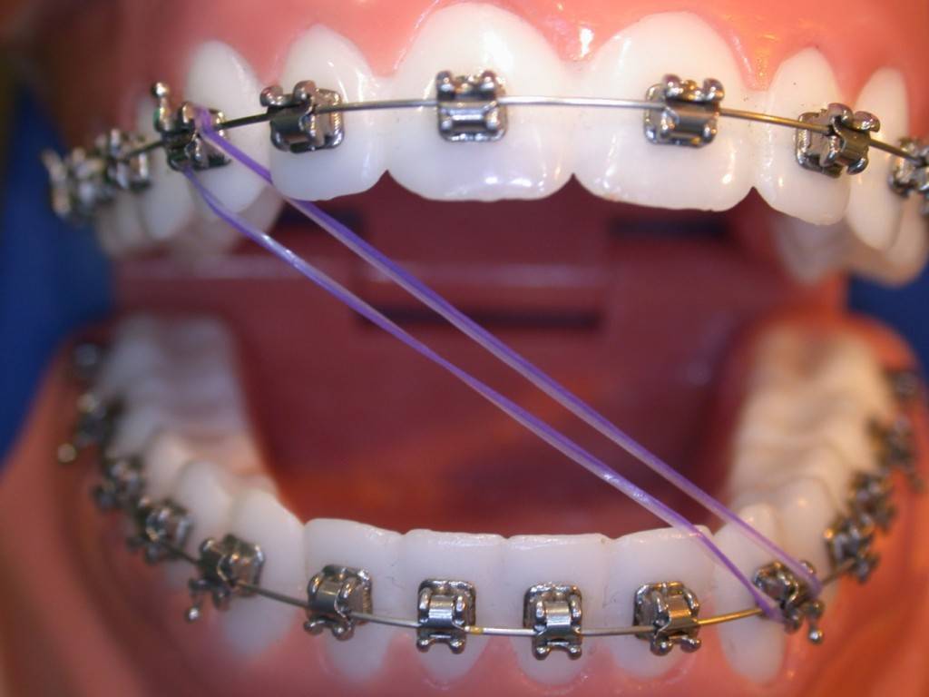 Что нужно сделать перед установкой брекетов — зубы