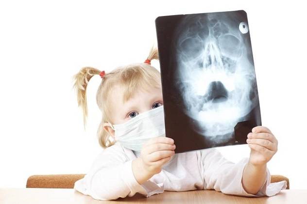 Синусит у ребенка — симптомы и особенности лечения