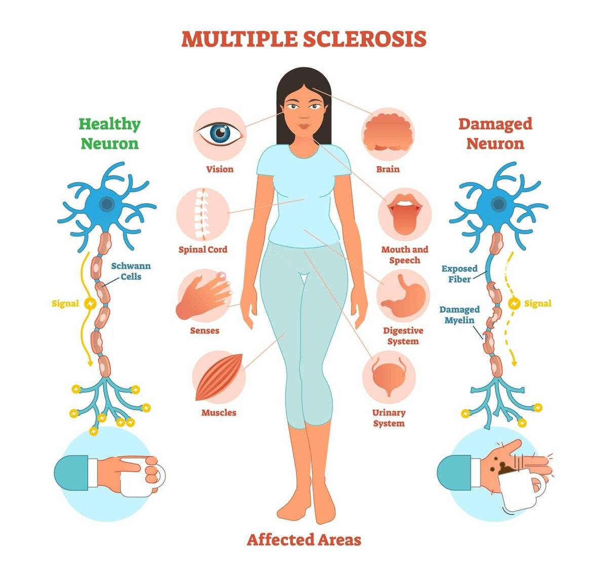 Признаки рассеянного склероза у женщин