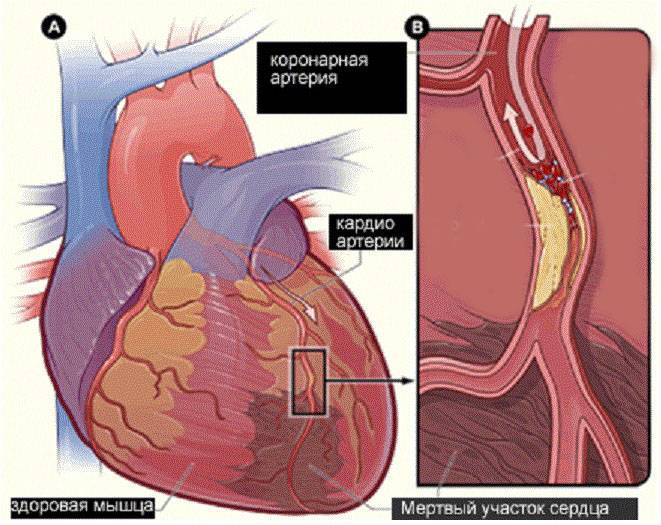 Атеросклеротический кардиосклероз (ибс): что это такое, диагноз и лечение