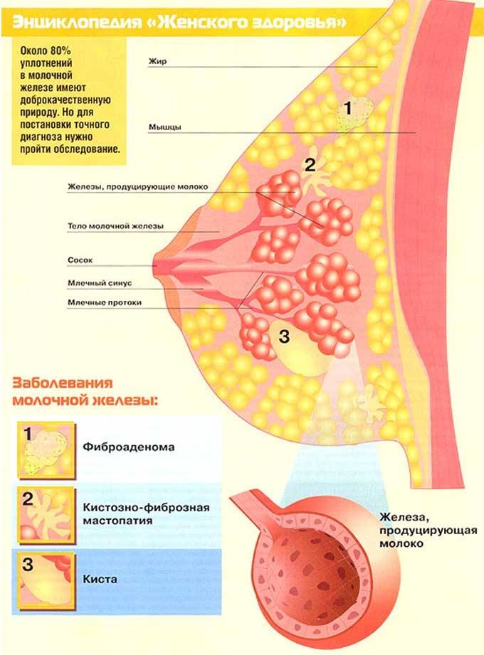 Мастопатия при климаксе: симптомы фиброзно-кистозной формы, лечение