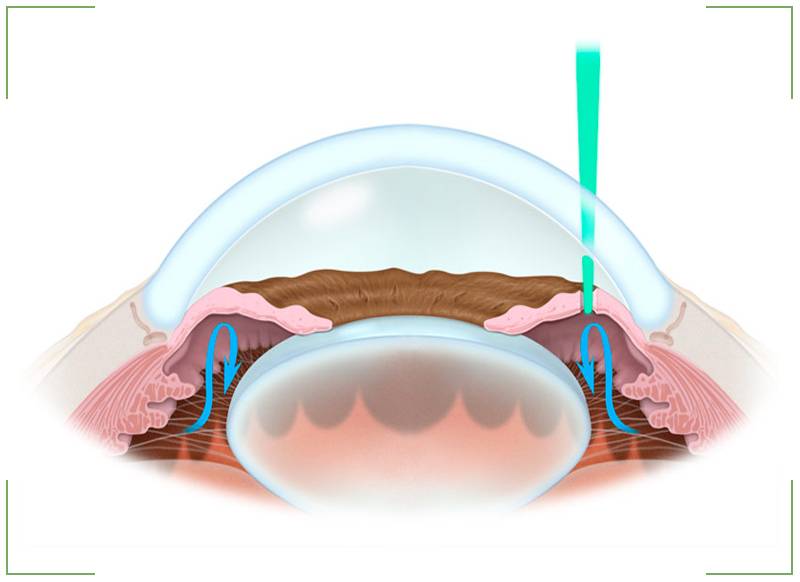 Лазерная дисцизия вторичной катаракты: что это такое, послеоперационный период после процедуры на задней капсуле хрусталика