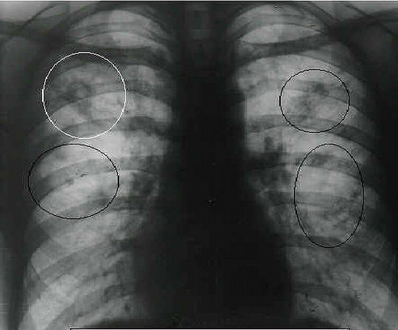 Инфильтративный туберкулез легких – заразен или нет, лечение