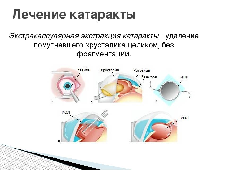 Лечение катаракты без операции - "здоровое око