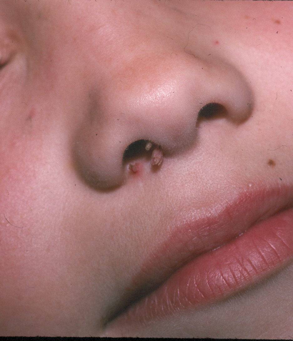 Полипы в носу у детей: симптомы и лечение, как выглядит полипоз