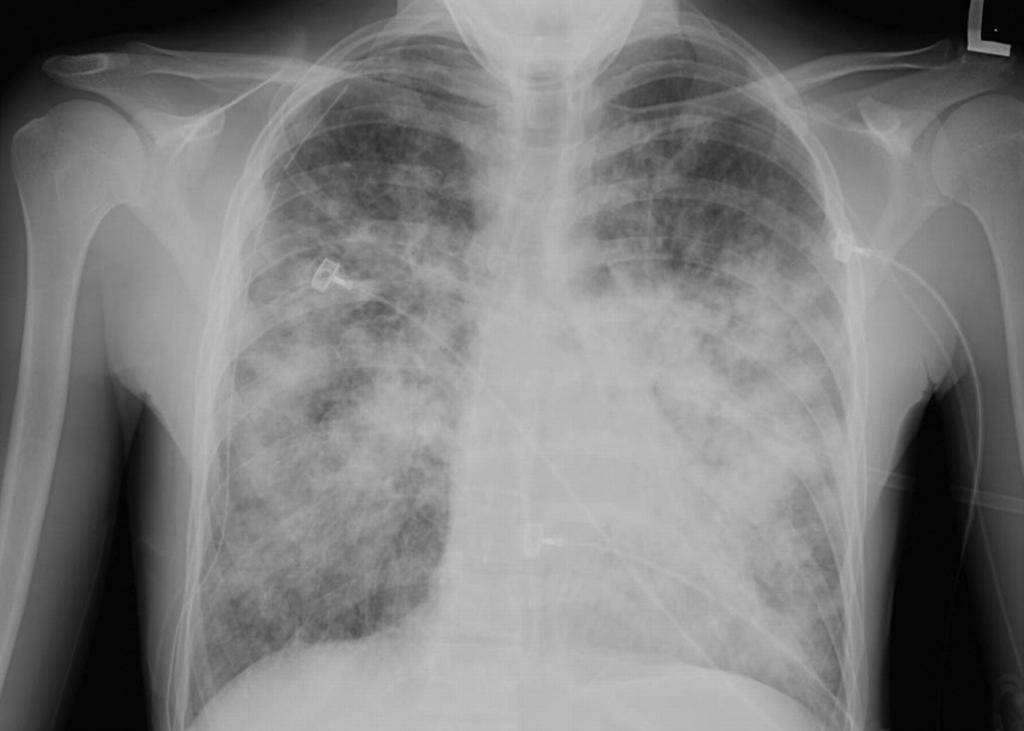 Пневмония на рентгене - признаки разных видов воспаления легких