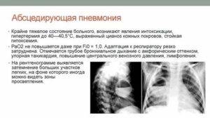 Деструктивная пневмония: что это такое и основные симптомы, на что указывает код мкб-10 и лечение бронхогенной и септической форм у взрослых | fok-zdorovie.ru