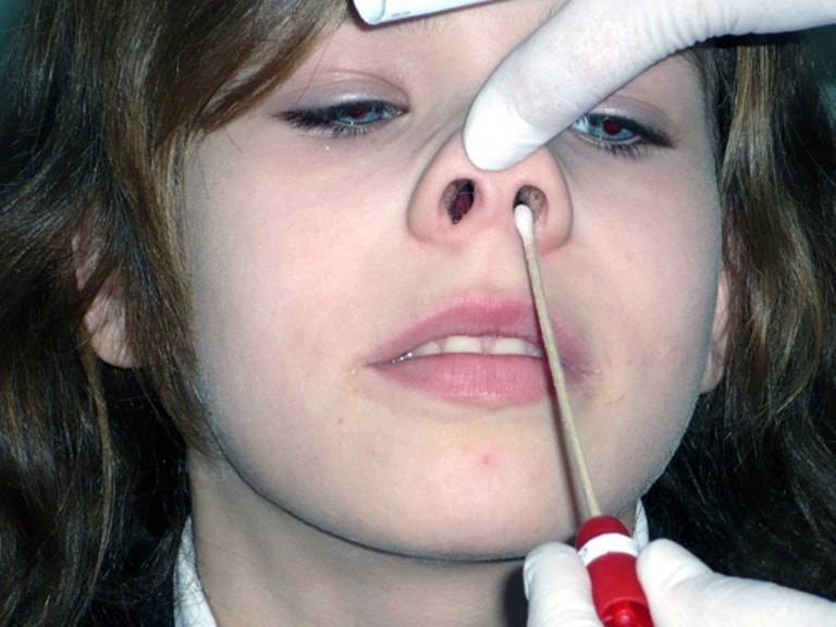 Как вылечить полипы в носу в домашних условиях без операции