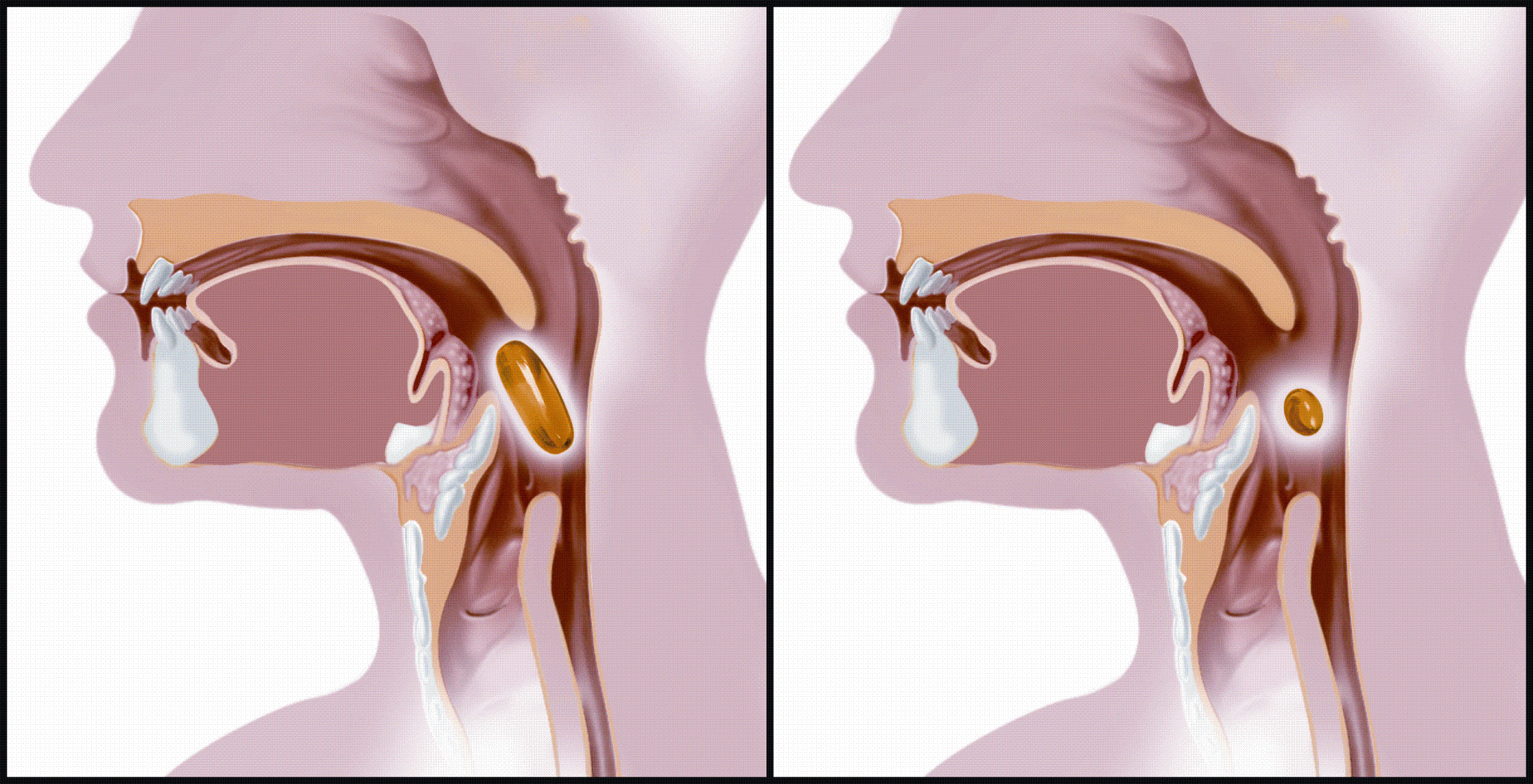 Комок в горле и трудно глотать: причины, лечение дисфагии – напоправку