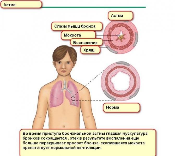 Как начинается астма: первые симптомы