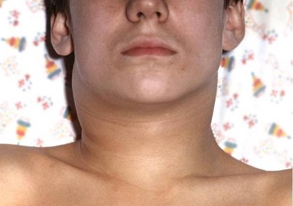Гнилостно-некротичесие флегмоны челюстно-лицевой области. принципы диагностики и лечения