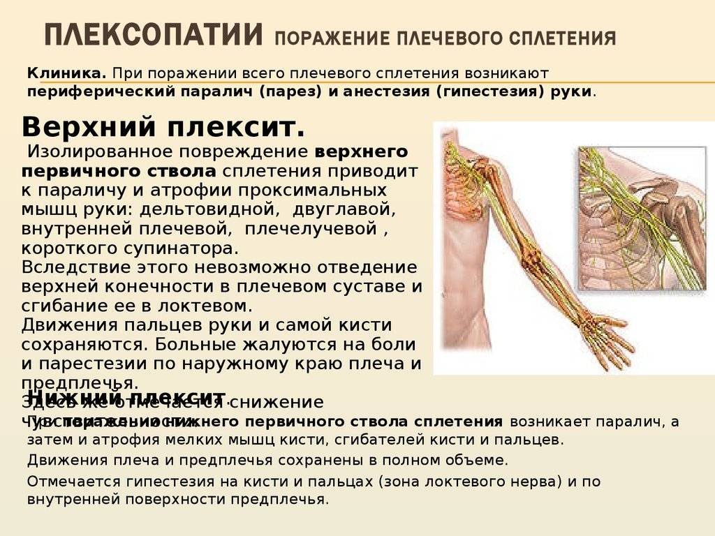Воспаление нерва плечевого сустава