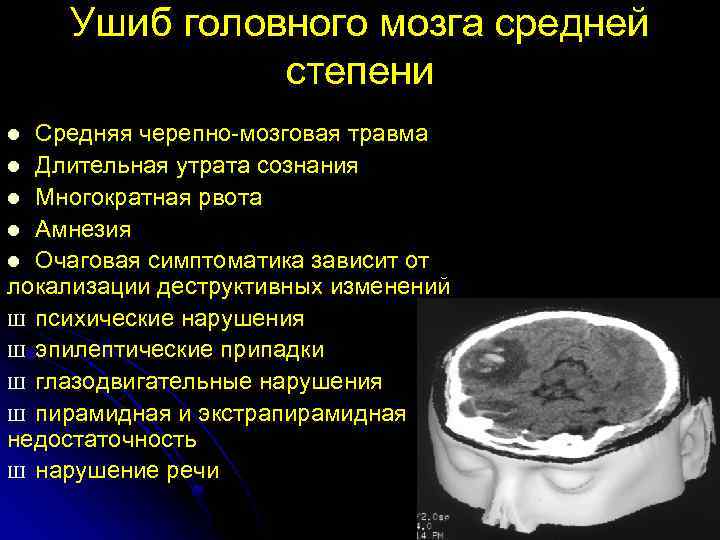 Степени и симптомы ушиба головного мозга: мкб-10, лечение
