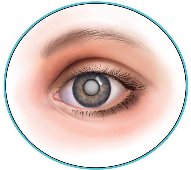Двоится в глазах (диплопия): причины и лечение, что делать в домашних условиях