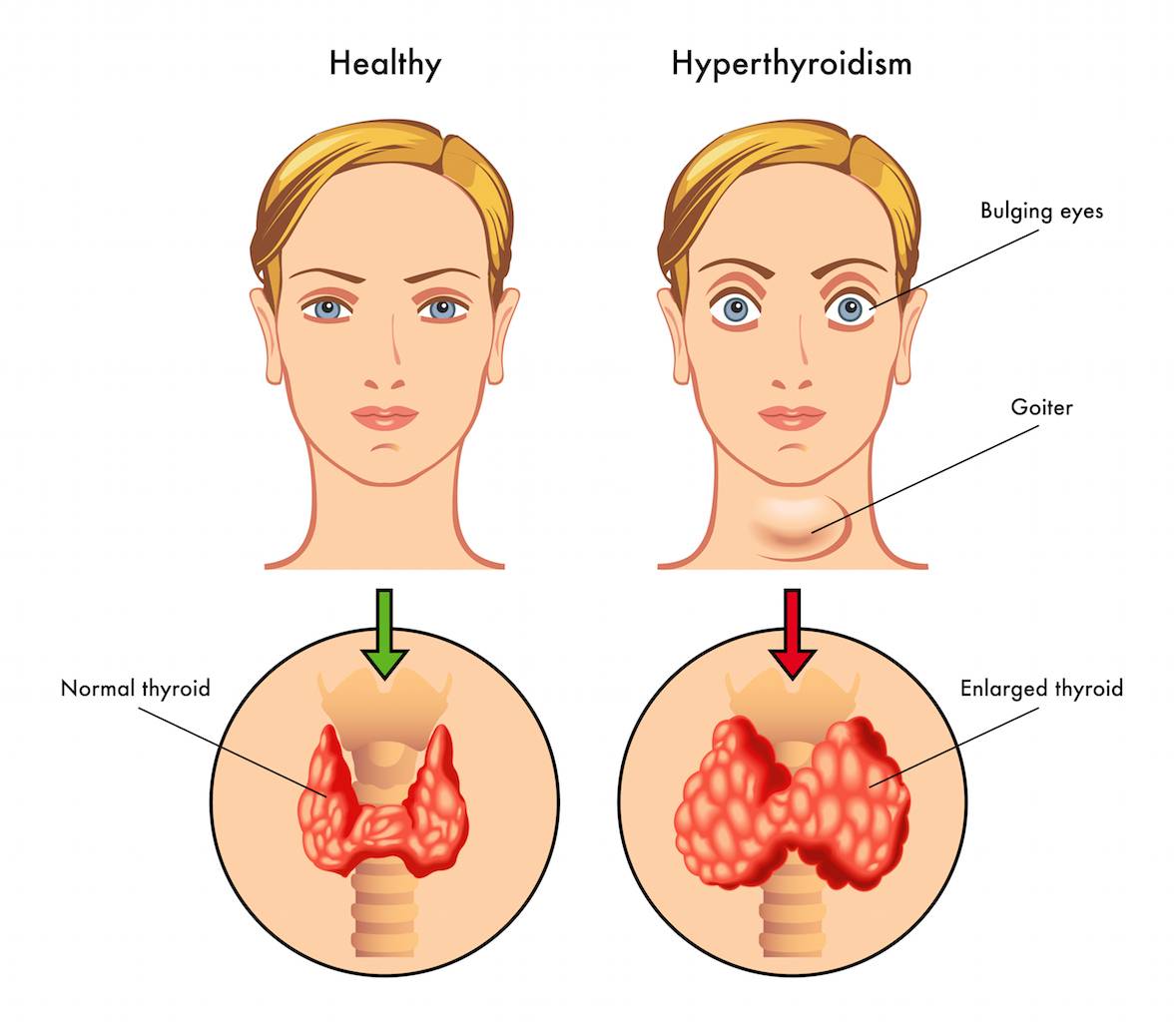 Тиреотоксикоз щитовидной железы — что это такое, симптомы, лечение, последствия. питание и диета при тиреотоксикозе щитовидной железы