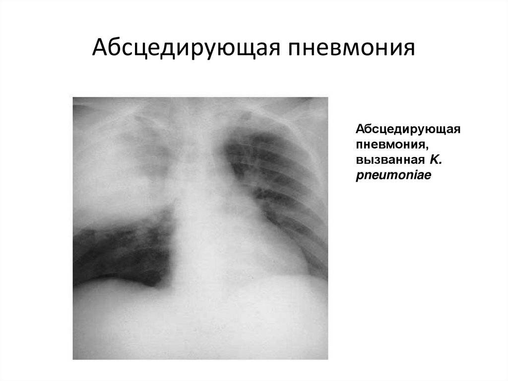 Абсцесс легкого (абсцедирующая пневмония): симптомы, лечение