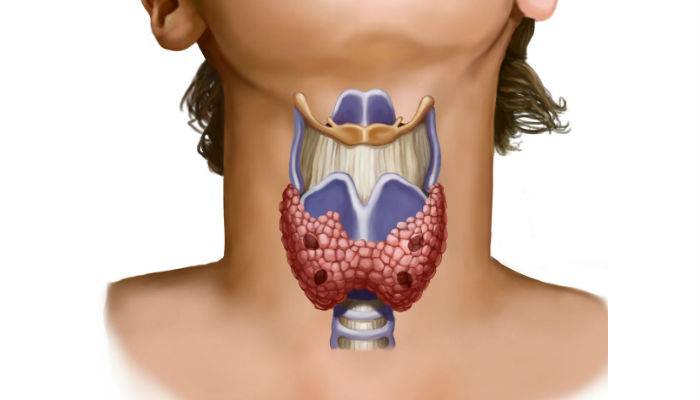 Тиреотоксикоз щитовидной железы: что это такое, симптомы, лечение