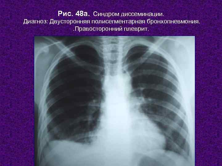 Мелкоочаговая пневмония у взрослых и детей: симптомы, диагностика и лечение
