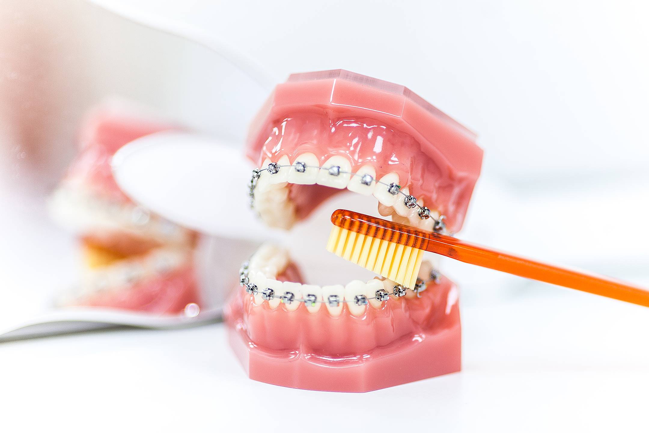 Этапы лечения брекетами: ношение по неделям и месяцам, как подтягивают конструкцию, за сколько выравниваются зубы после установки