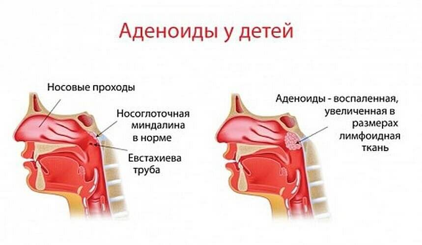 Аденоиды в носу у детей - симптомы и лечение, фото