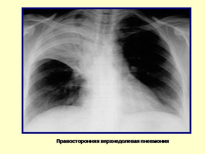 Левосторонняя верхнедолевая и нижнедолевая пневмония у взрослых и детей: симптомы, лечение