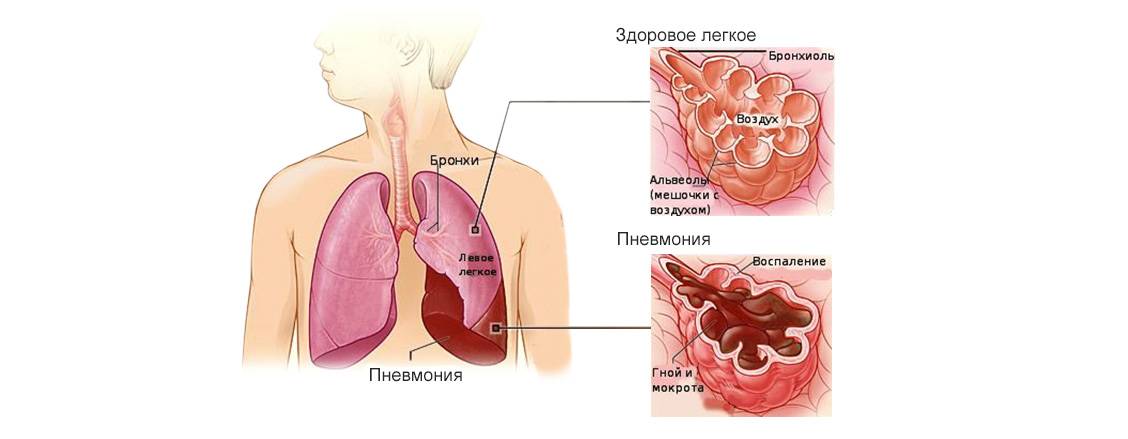 Бессимптомная пневмония у взрослых - может ли протекать воспаление легких без симптомов