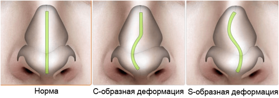 Врожденные аномалии [пороки развития] носа. код по мкб-10 q30