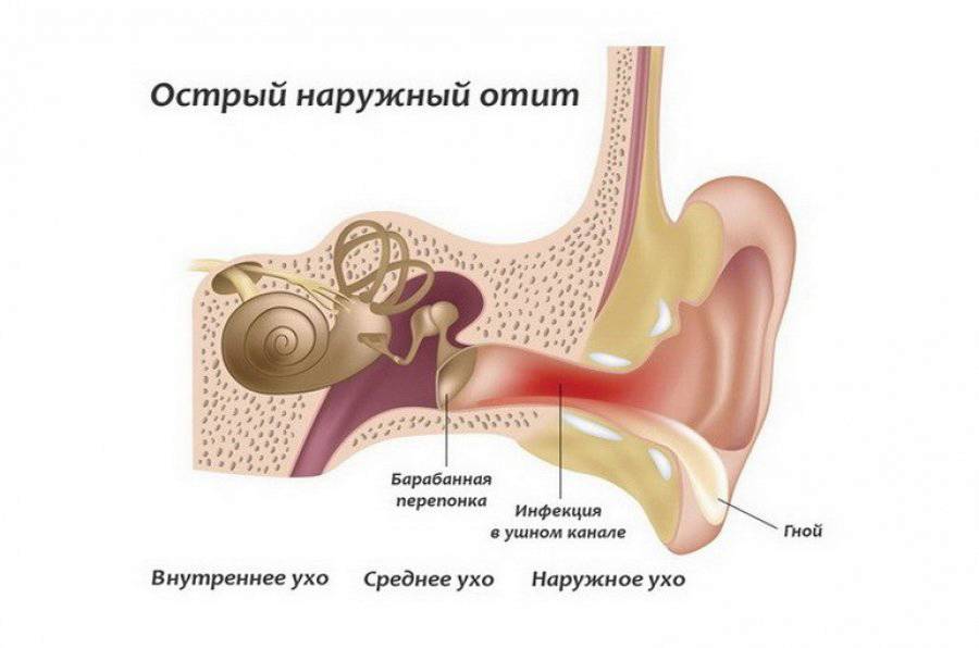 Лечение гнойного отита у взрослых, как лечить хронический отит среднего уха препаратами