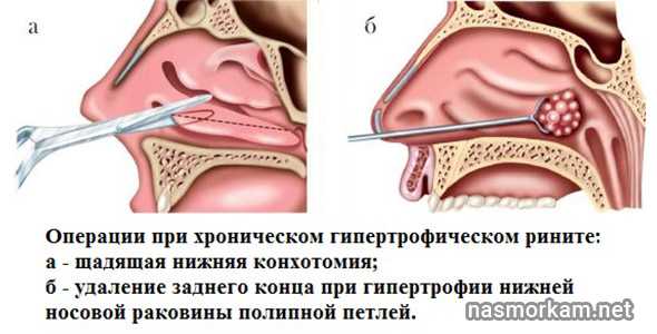 Гиперпластический ринит: что это такое хроническая гиперплазия слизистой носовых ходов, симптомы и признаки