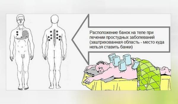 Можно ли ставить горчичники при пневмонии и как делать это правильно pulmono.ru
можно ли ставить горчичники при пневмонии и как делать это правильно
