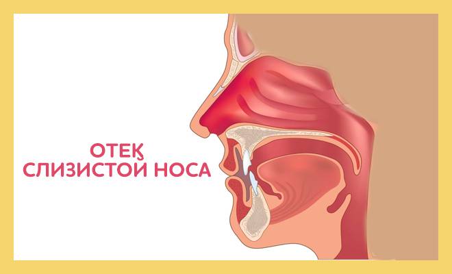 Отек слизистой носа без насморка: причины и лечение