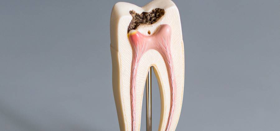 Депульпация зуба перед протезированием: что это такое. кому необходимо депульпирование