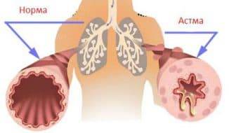 Бронхиальная астма - мкб-10 код у взрослых, приступы удушья, атопическая, смешанная, неуточненная, аллергическая