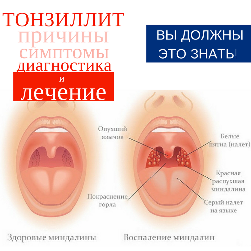 Катаральная ангина у взрослых: симптомы, причины и лечение