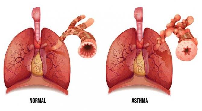 Виды астмы: основные принципы и критерии классификации заболевания
