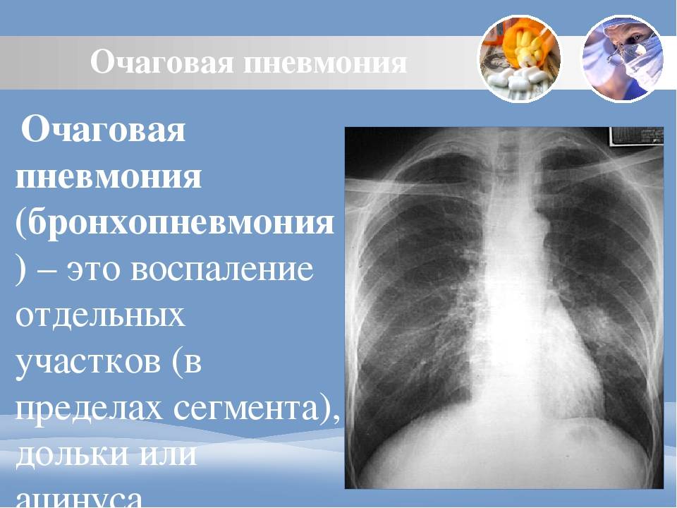 Очаговая пневмония симптомы и лечение — proinfekcii.ru