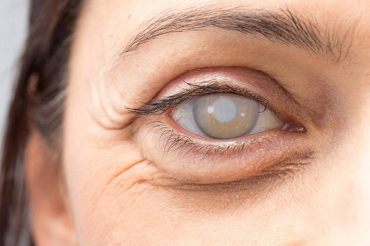 Лечение катаракты народными средствами