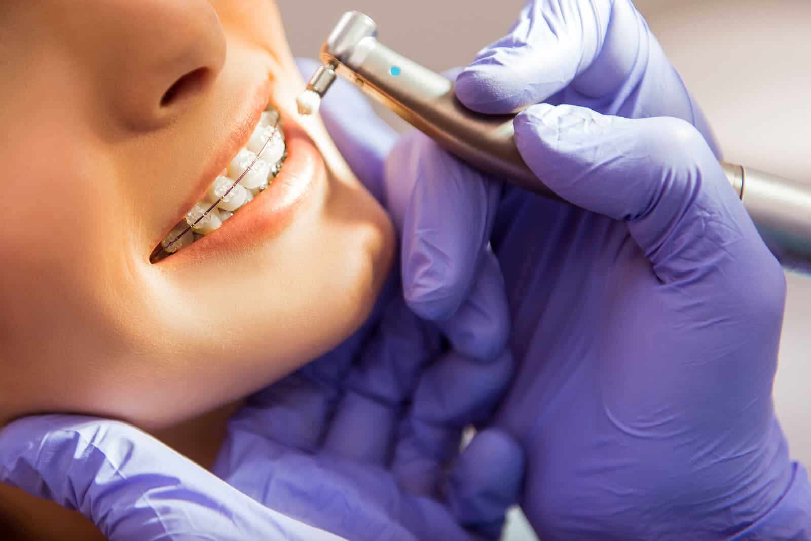 Подготовка к выравниванию зубов: нужна ли чистка перед брекетами?
