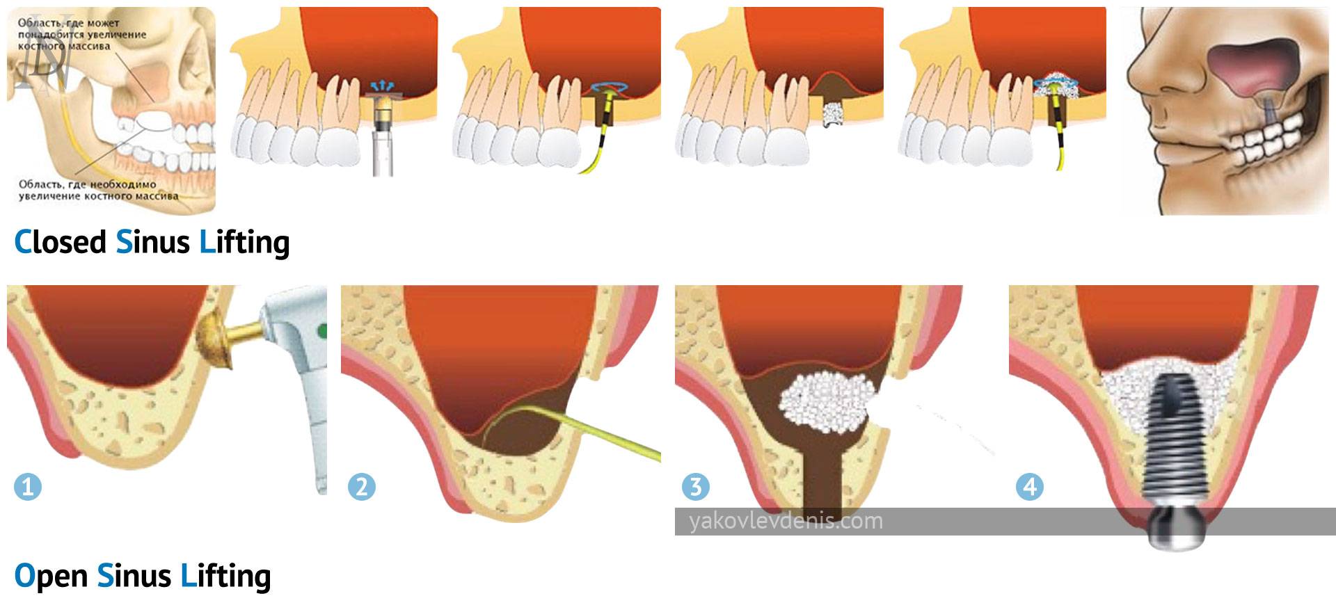 Синус-лифтинг - что это такое? использование при имплантации зубов, цена и отзывы