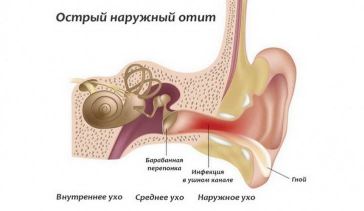 Отит среднего уха. острый, хронический, гнойный, катаральный средний отит – симптомы и лечение
