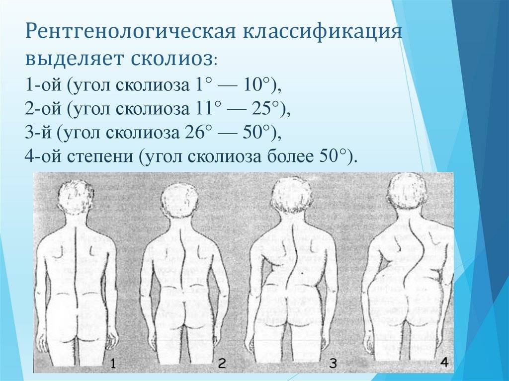 Сколиоз 1 и 2 степени симптомы и консервативное лечение взрослых и детей в москве