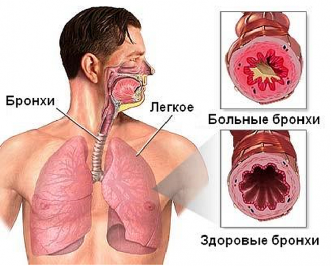 Кашлевая форма бронхиальной астмы