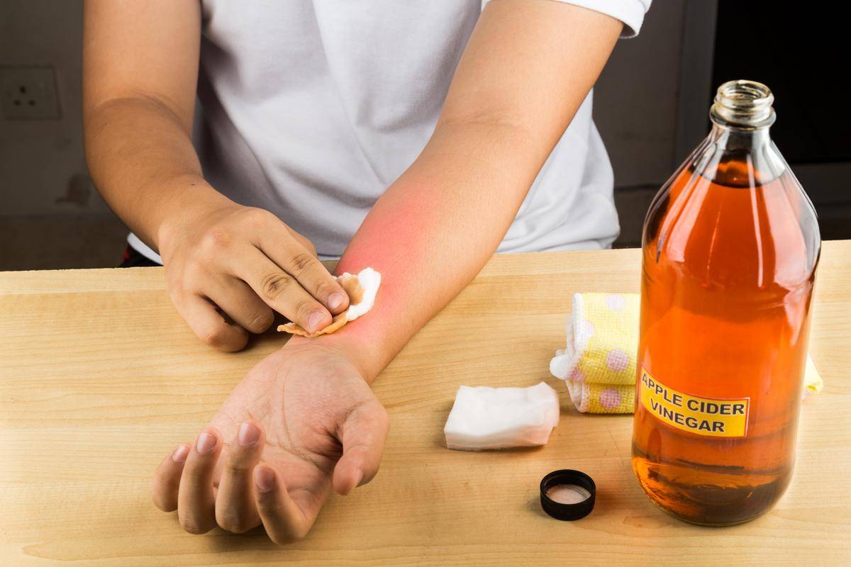 Химический ожог кожи: что делать и чем лечить в домашних условиях?