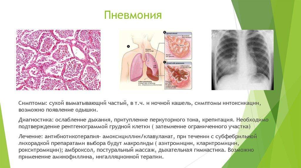 Пневмония - причины, симптомы, диагностика и лечение